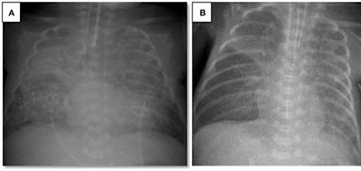 Endotracheal Surfactant Combined With Budesonide for Neonatal ARDS